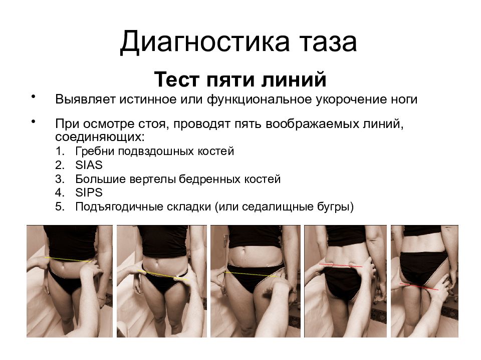 Как определить правильность расположения таза Анатомия, биомеханика таза. Остеопатические диагностика и лечение (МЭТ) - презен