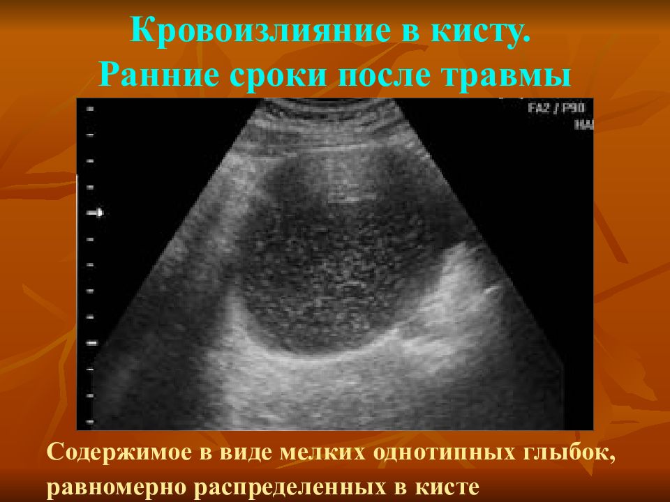 Виды кист. Кровоизлияние в кисту почки на УЗИ.