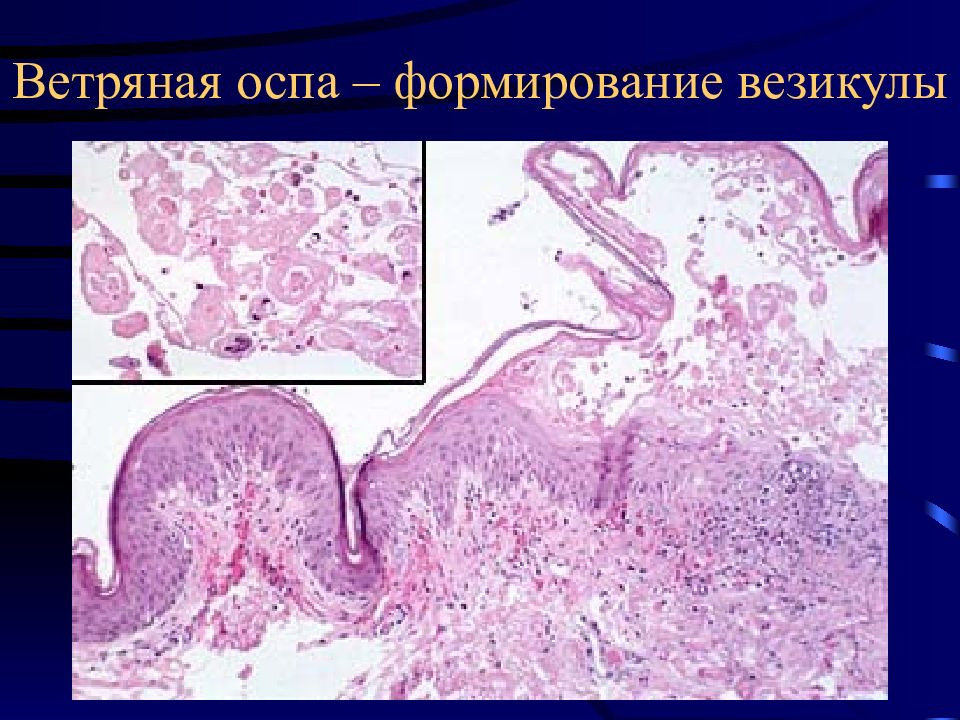 Менингококковая инфекция патологическая анатомия презентация