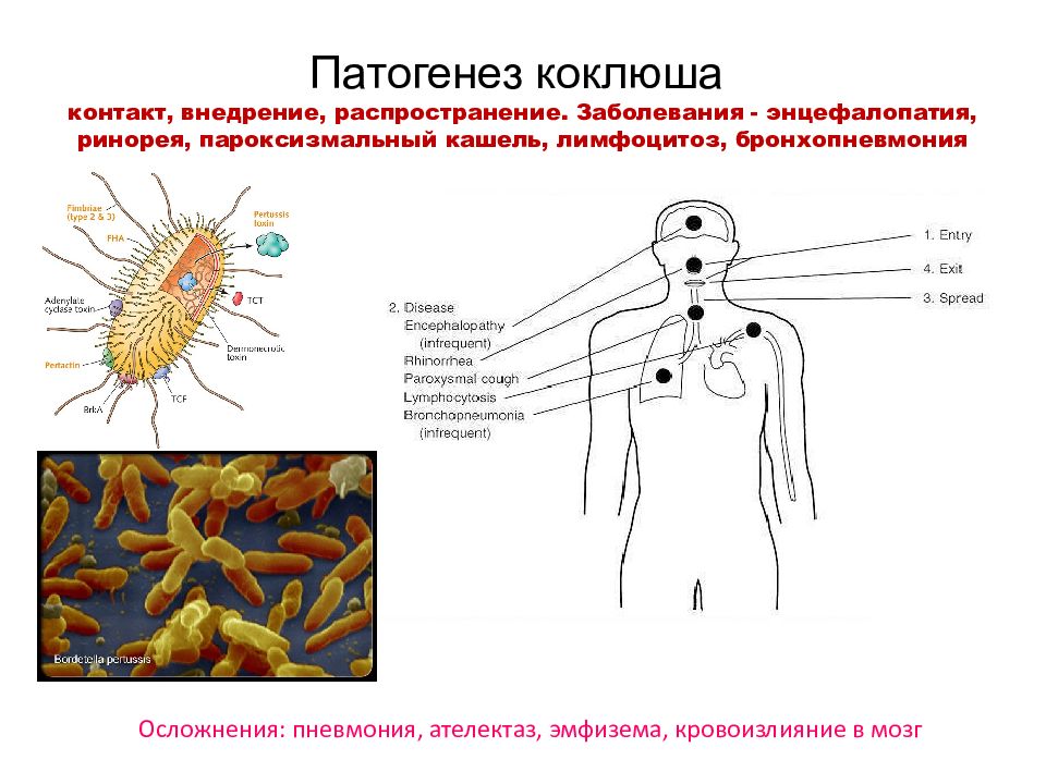 Патогенез дифтерии схема