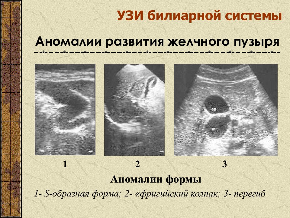 Обобщенная эхографическая картина рака желчного пузыря может быть представлена