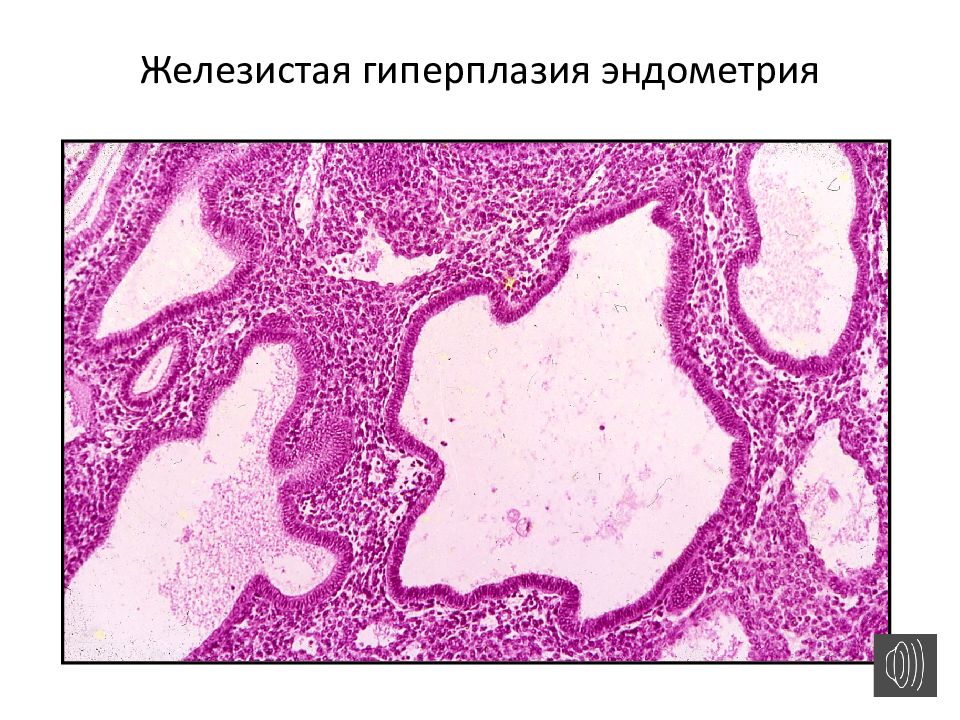 Кистозно расширенная железа. Гиперплазия эндометрия микроскопия. Простая гиперплазия эндометрия гистология. Неатипическая железистая гиперплазия. Гиперплазия матки гистология.