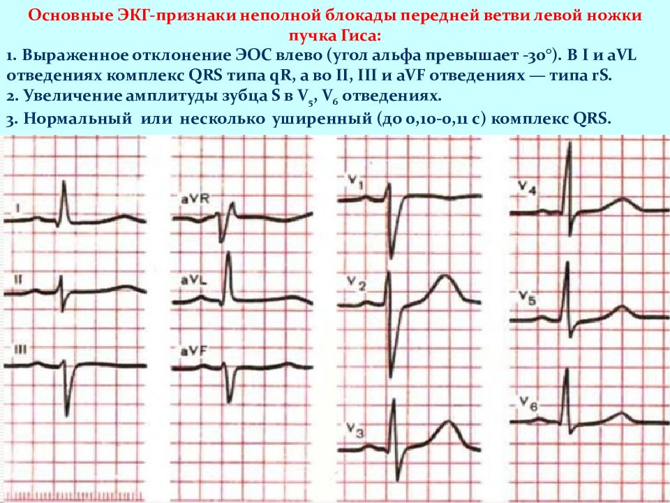 Картинки полная блокада левой ножки пучка гиса