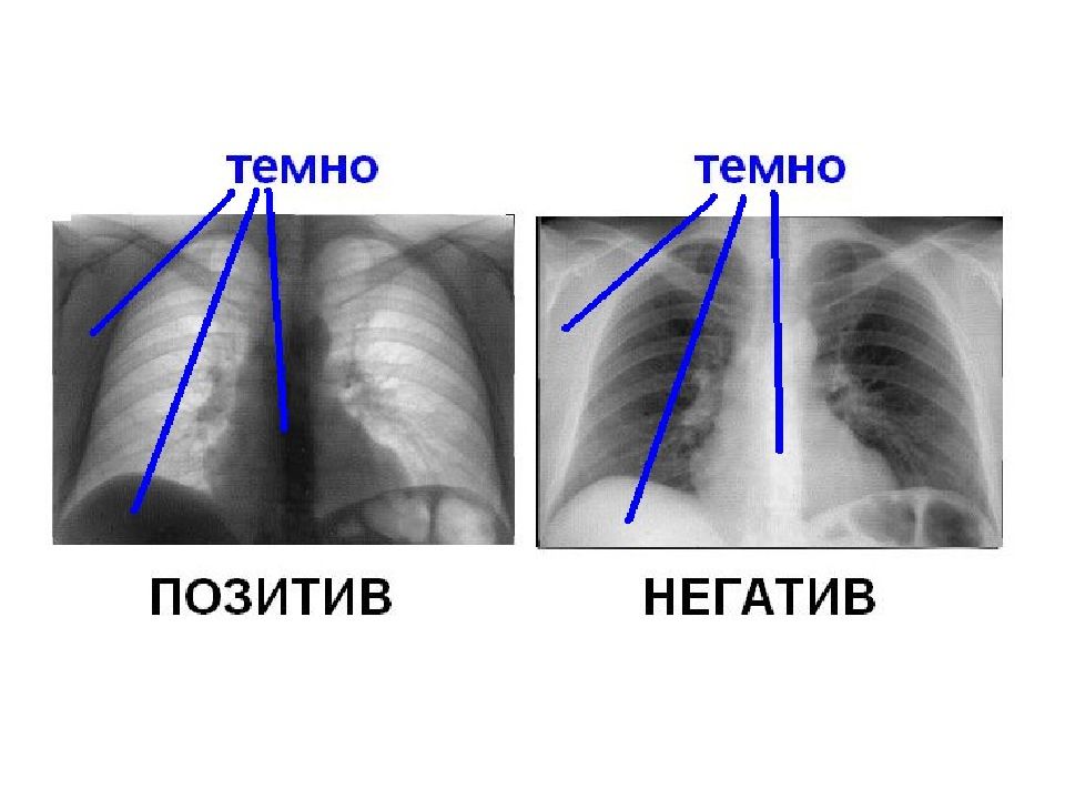 Негативное изображение рентген