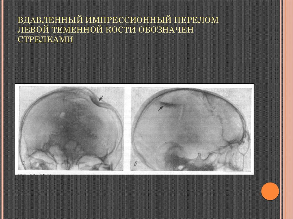 Импрессионный перелом. Импрессионный перелом черепа на кт. Вдавленный перелом теменной кости. Вдавленный импрессионный перелом черепа. Импрессионный перелом лобной кости.