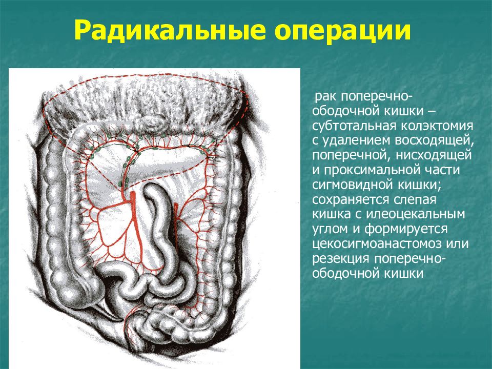 Боли нисходящая ободочная кишка. Сигмовидная колэктомия. Ректо сигмовидный отдел толстой кишки. Голотопия поперечно ободочной кишки. Слепая кишка и сигмовидная ободочная.