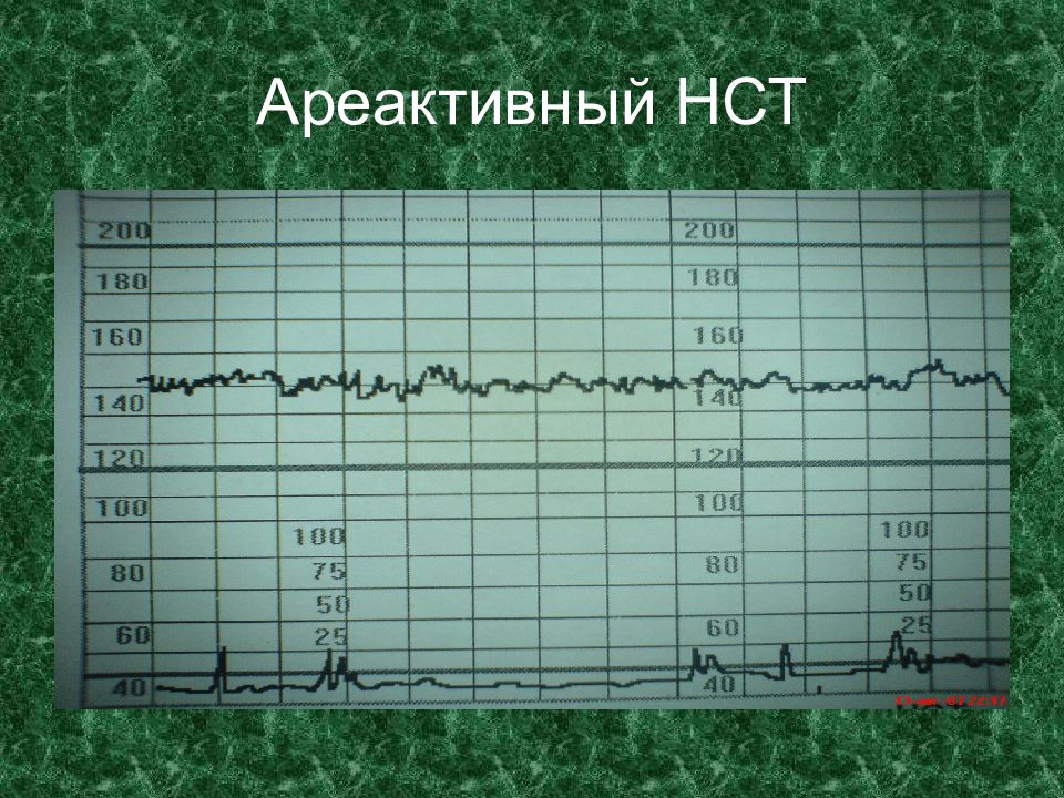 Ктг. Синусоидальный ритм КТГ. Реактивный нестрессовый тест КТГ. Вариабельность сердечного ритма на кт. Синусовый ритм КТГ.