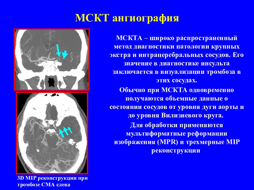 Мскт это. Мультиспиральная компьютерная томография-ангиография. Мультиспиральная кт ангиография. Метод кт диагностики.