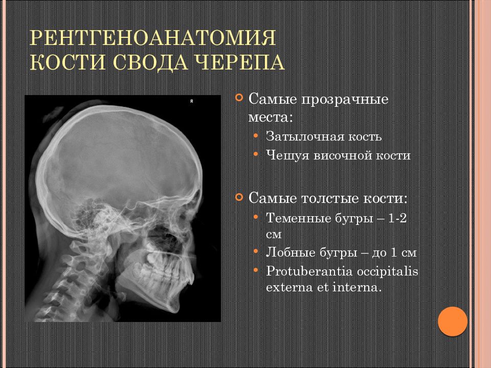 Кт лицевых костей. Туберкулез костей лицевого черепа. Остеопороз костей свода черепа. Чешуя височной кости. Пластика костей свода черепа.