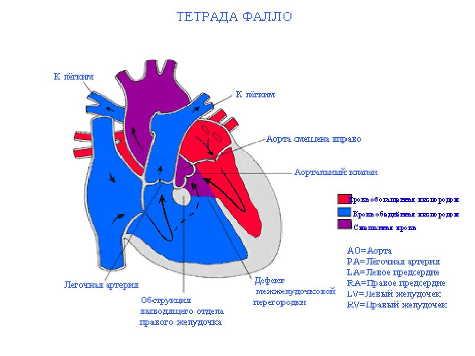 Тетрада фалло