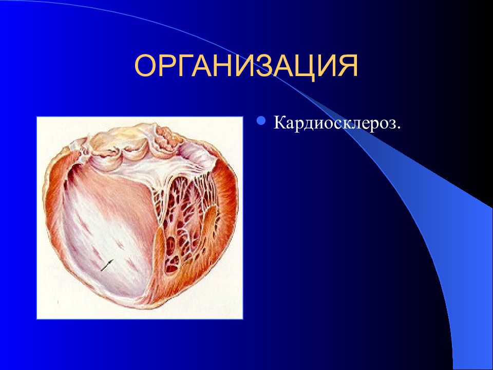 Ибс атеросклероз кардиосклероз. Эндокардиальный кардиосклероз. Кардиосклероз метаплазия. Крупноочаговый кардиосклероз. Постинфарктный кардиосклероз макро.