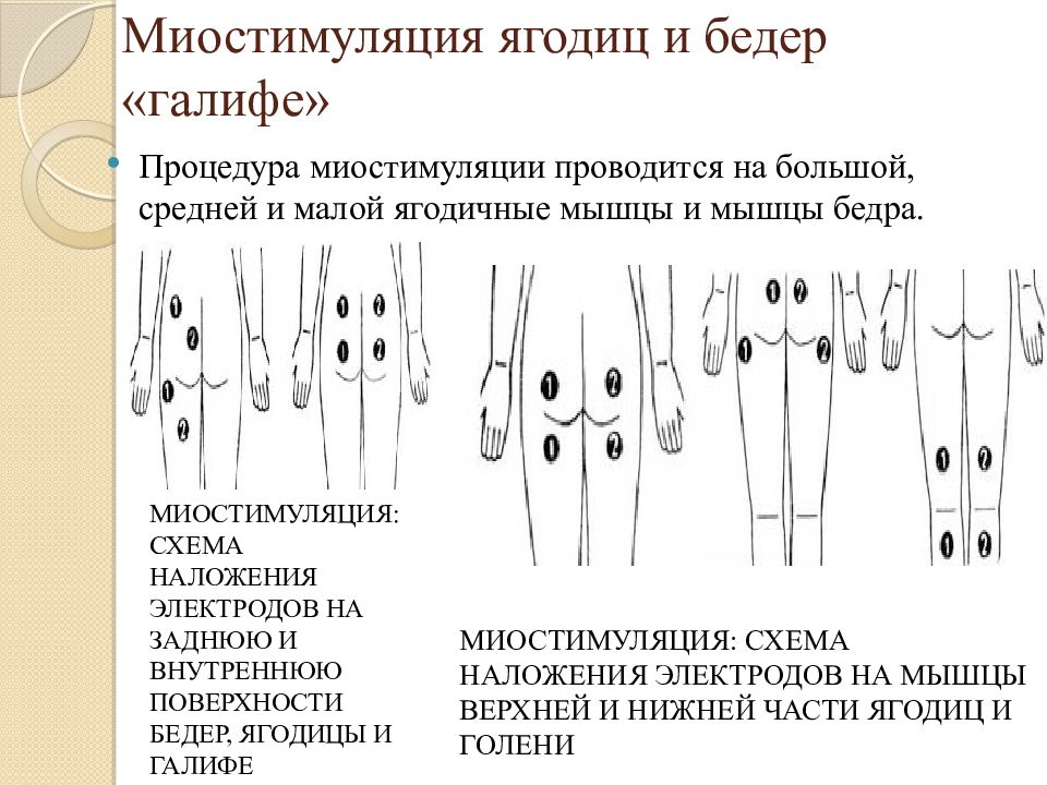 Схема миостимуляции тела наложения электродов при миостимуляции