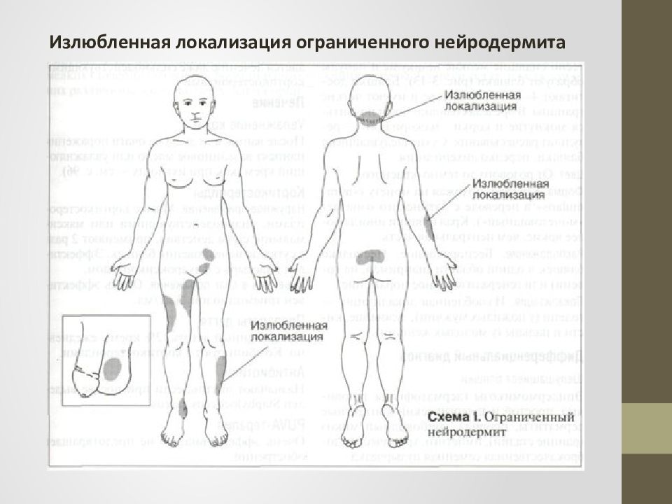 Нейродермит что это и схема лечения