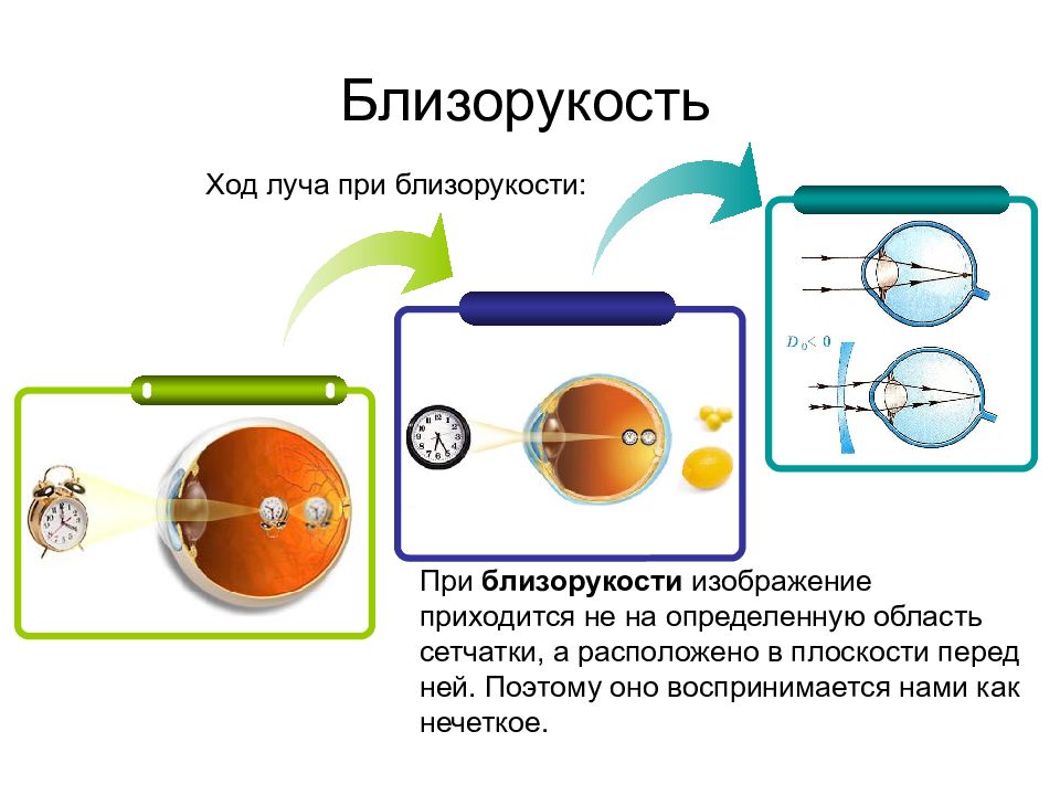 Близорукость картинки для презентации