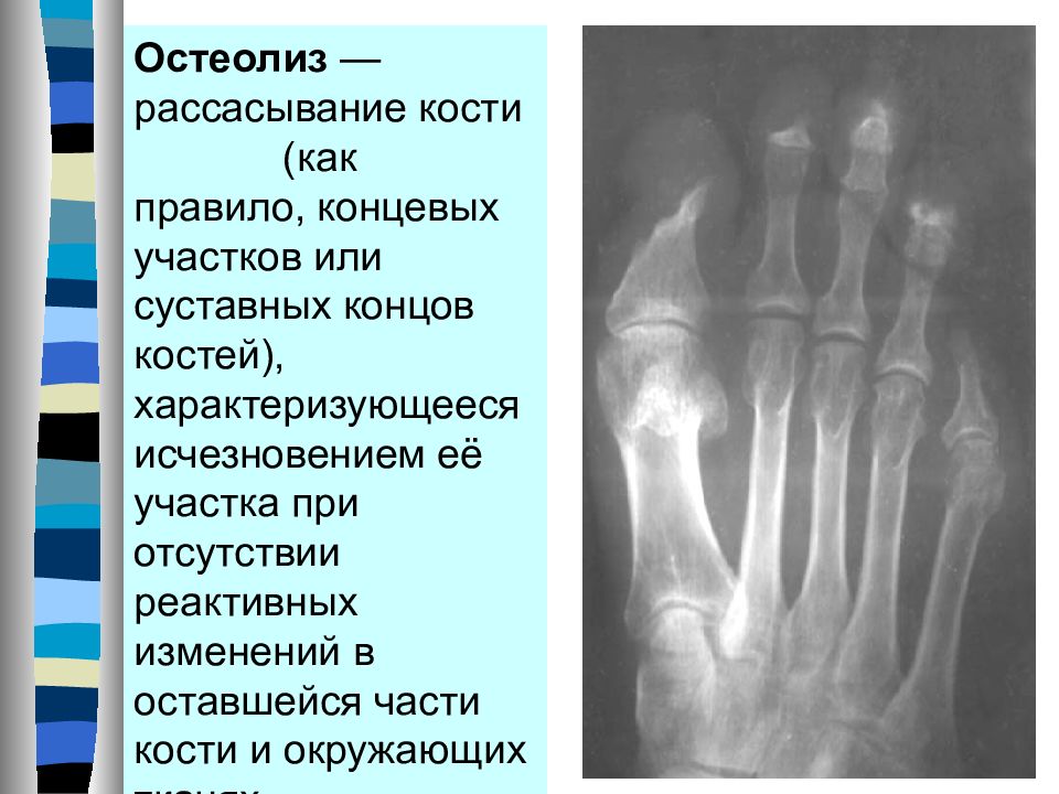 Остеолиз это. Остеолиз фаланг пальцев стопы. Остеолиз концевых фаланг. Остеолиз костей рентген.