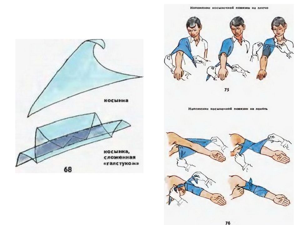 Косыночные повязки виды. Косыночные повязки. Косыночная повязка наложение. Техника наложения косыночной повязки на кисть. Косыночная повязка на локоть.