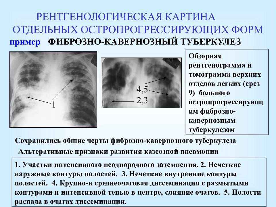 Туберкулез легких карта вызова