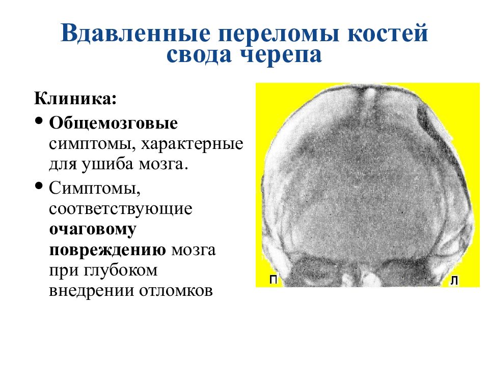 Кости свода. Импрессионный вдавленный перелом свода черепа. Перелом костей черепа клиника. Перелом свода черепа клиника. Перелом основания черепа клиника.