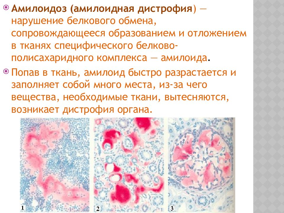 Амилоидоз клинические рекомендации