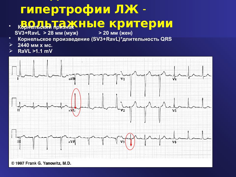 Вольтажная гипертрофия левого желудочка. ЭКГ при инфаркте миокарда с подъемом St. Острый коронарный синдром с подъемом St на ЭКГ. Инфаркт миокарда с подъемом сегмента St ЭКГ. ЭКГ при инфаркте миокарда без подъема сегмента St.