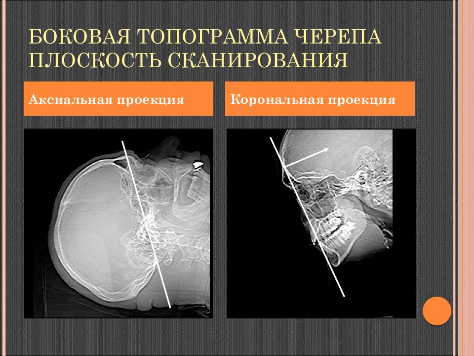 Аксиальная проекция. Корональная проекция. Аксиальная и корональная проекция. Аксиальная проекция кт.