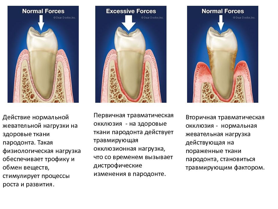 Этиология патогенез клиника заболеваний пародонта презентация