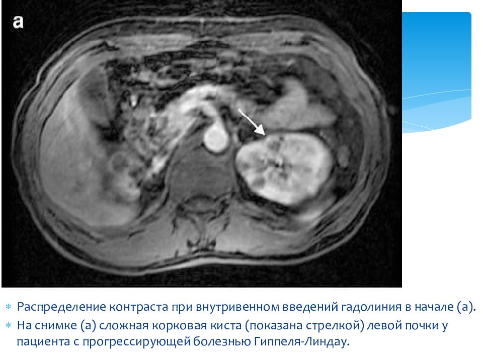 Мрт контраст киста. Болезнь Гиппеля Линдау почки кт. Введение контраста. Введение контраста при мрт.