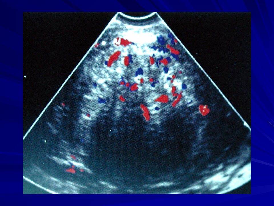 Ультразвуковая дифференциальная диагностика. Цветовое допплеровское картирование миома матки. Ультразвуковая диагностика миомы матки. Миома матки кровоток УЗИ.