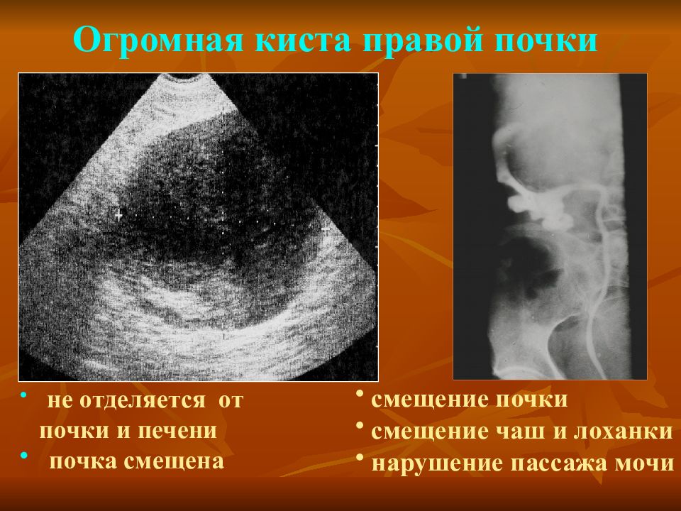 Правая киста. Гигантская киста почки. Киста в почечной лоханке.