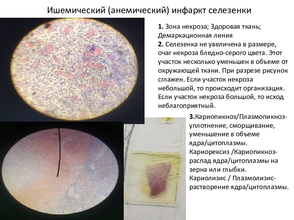 Ишемический (анемический) инфаркт селезенки