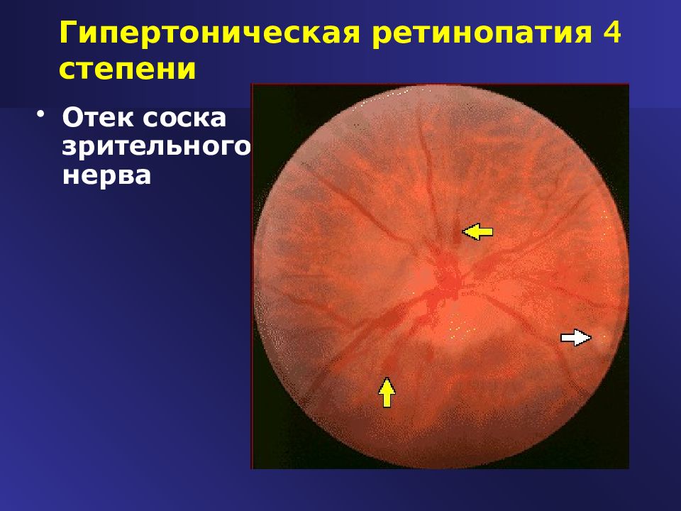 Гипертоническая ретинопатия презентация