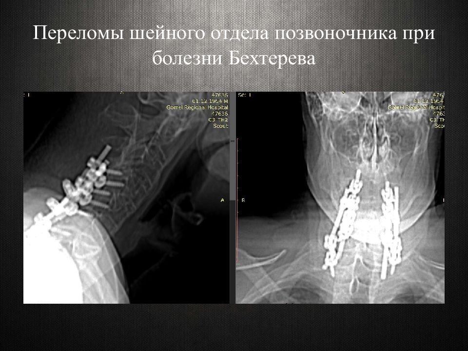 Перелом шейного позвонка фото