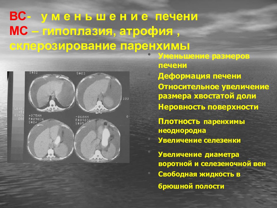 Гипоплазия почки. Гипоплазия селезенки кт. Гипоплазия отдельных долей печени. Гипоплазия квадратной доли печени. Аномалии развития печени.