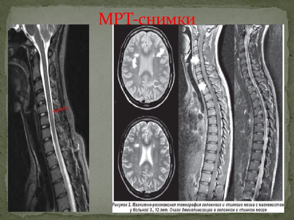 Рассеянный склероз костного мозга. Рассеянный склероз на мрт позвоночника. Рассеянный склероз шейного отдела мрт. Рассеянный склероз снимок мрт. Демиелинизация спинного мозга мрт.