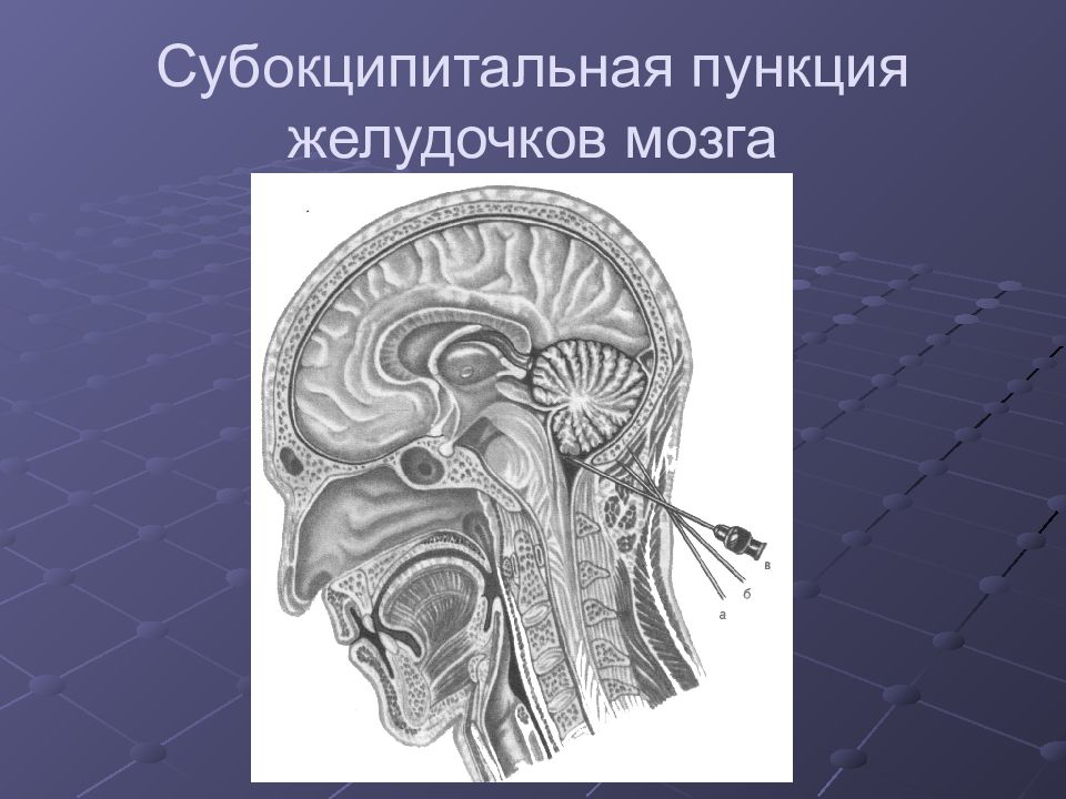 Пункция мозга. Субокципитальная пункция. Пункции вентрикулярная субокципитальная. Субокципитальный ликвор. Пункция желудочков мозга анатомия.