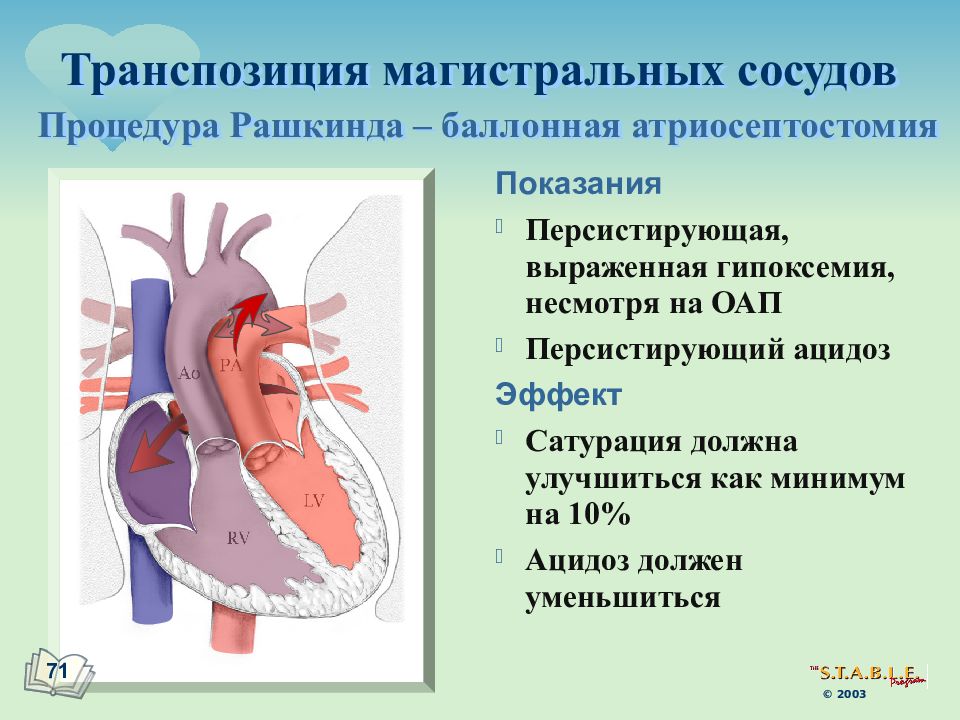 Магистральные сосуды это. Баллонная атриосептостомия Рашкинда. Операция при транспозиции магистральных сосудов. Процедура Рашкинда при транспозиции магистральных сосудов. Транспозиция магистральных сосудов и открытый артериальный проток.