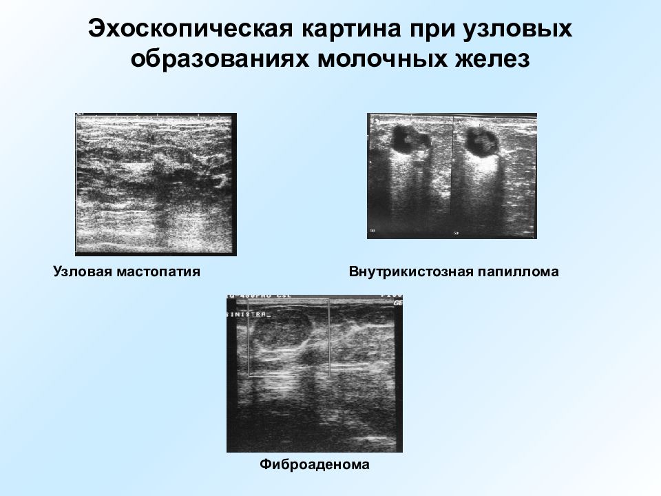 Узловое образование молочных желез. Дисгормональная мастопатия молочных желез. Дисгормональная гиперплазия молочных желез. Узловая мастопатия на УЗИ молочной железы. Дисгормональная гиперплазия молочной железы.