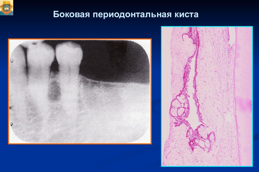 Опухоли опухолеподобные поражения и кисты кожи лица презентация