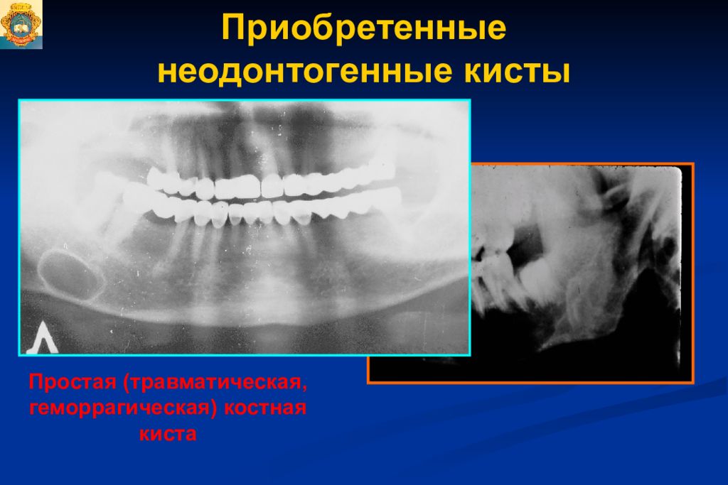 Неодонтогенные опухоли челюстей презентация