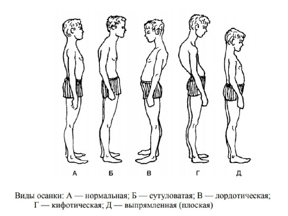 Рассмотрите рисунки 1 4 на каком из них изображен подросток с нормальной осанкой