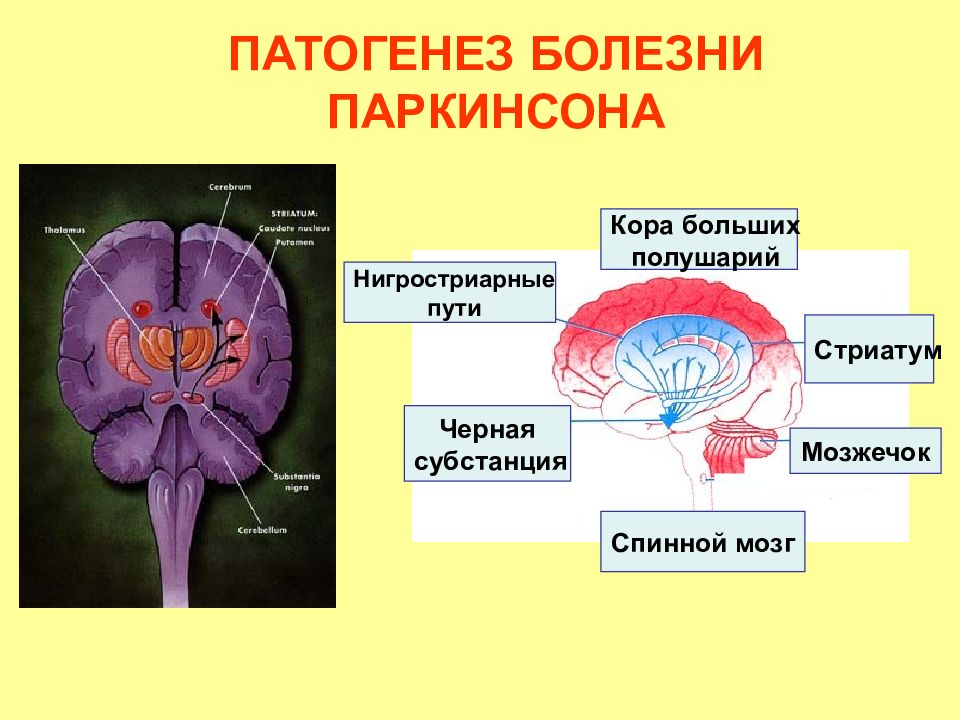 Этиология и патогенез болезни паркинсона презентация