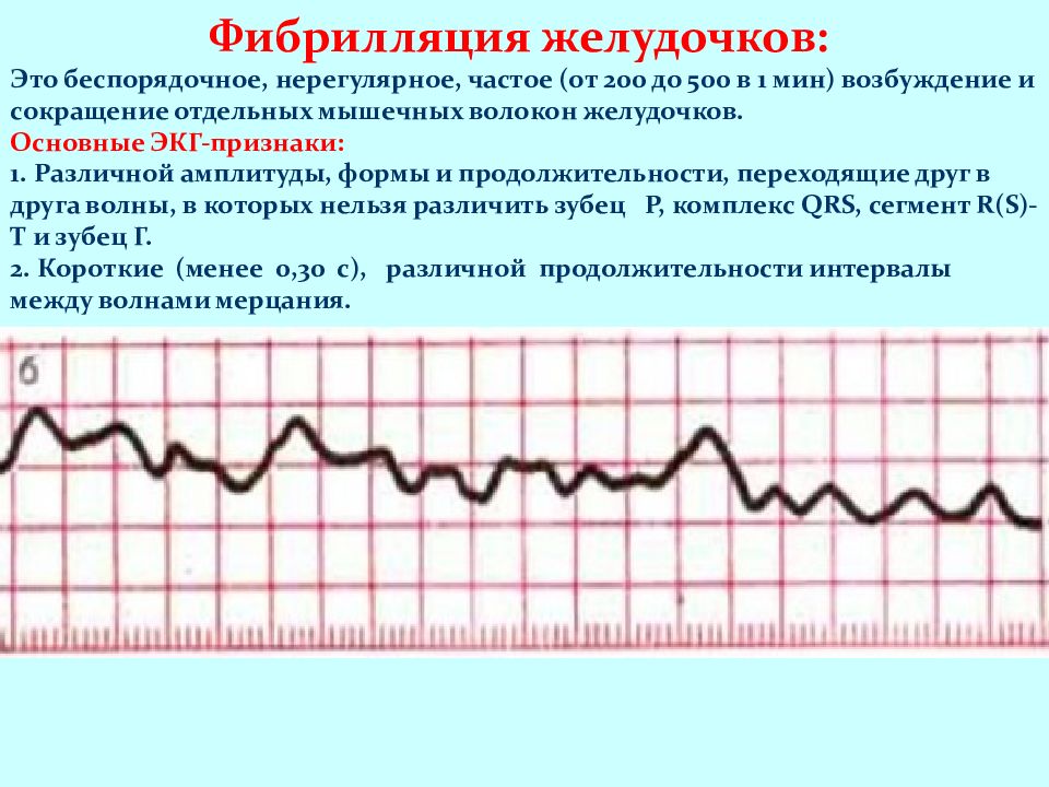 Экг при нарушениях ритма и проводимости презентация