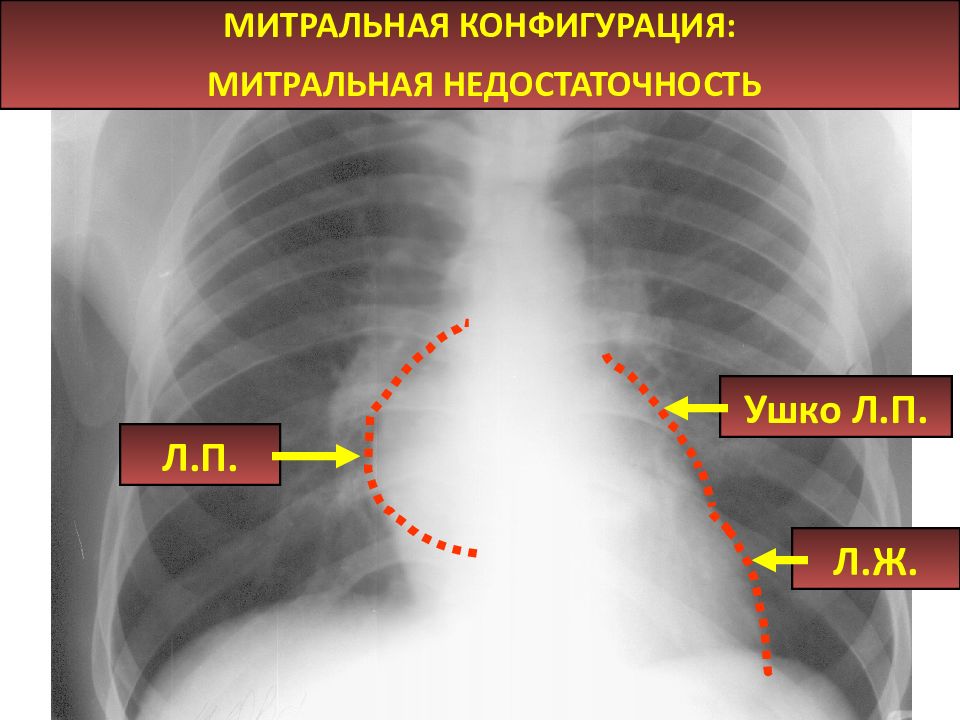 Трапециевидное сердце. Митральная конфигурация сердца на рентгенограмме. Митральная конфигурация сердца рентген. Митральная и аортальная конфигурация сердца на рентгене. Патологические конфигурации сердца.