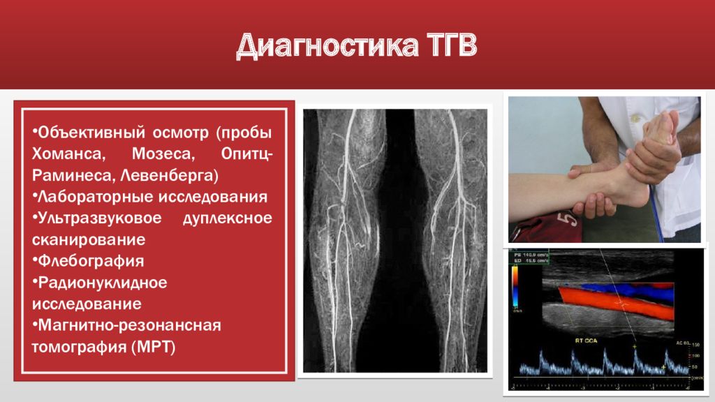Мкб 10 тромбоз глубоких вен нижних. Тромбофлебит диагностика. Тромбоз глубоких вен клиника. Тромбоз глубоких вен лабораторная диагностика.