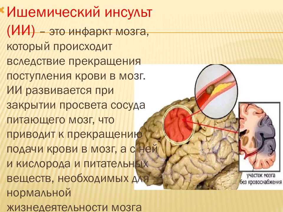 Инфаркт головного мозга