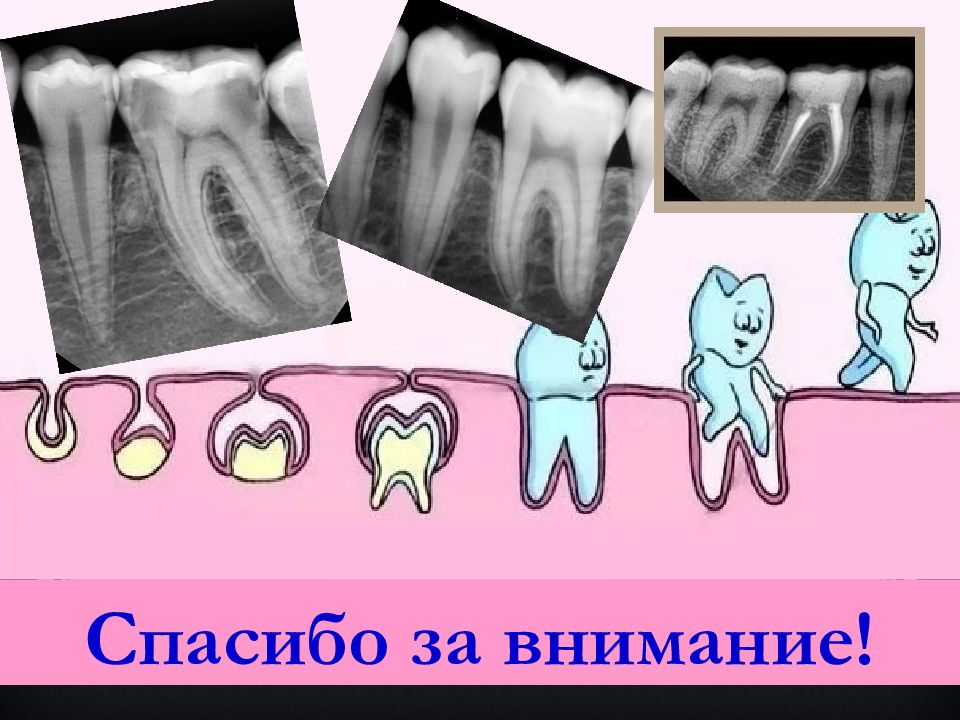 Пломбирование каналов презентация