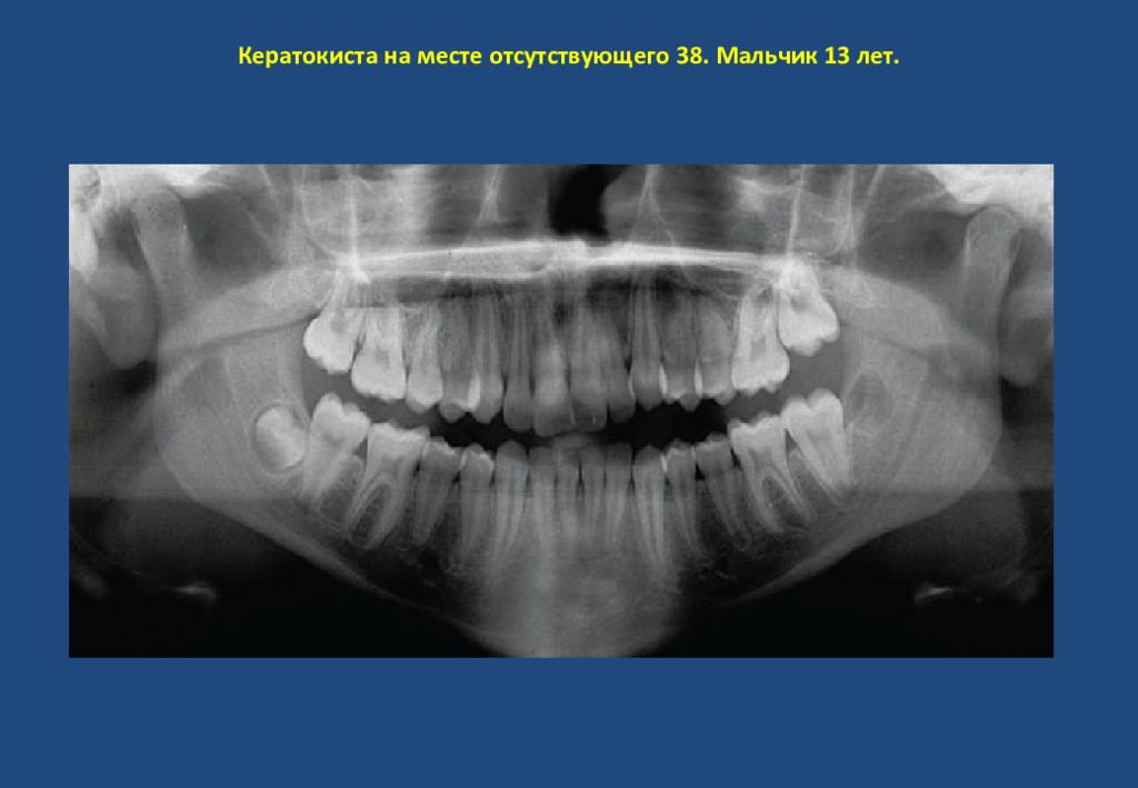 Местами отсутствуют. Первичная киста кератокиста. Одонтогенная кератокиста. Кератокиста нижней челюсти.