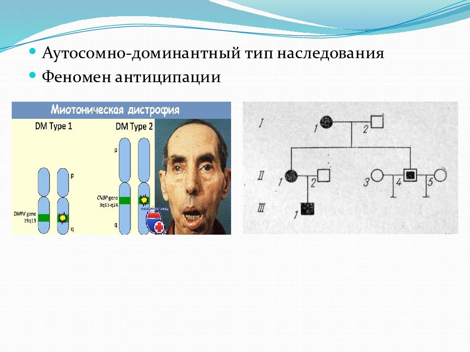 Миотоническая дистрофия презентация