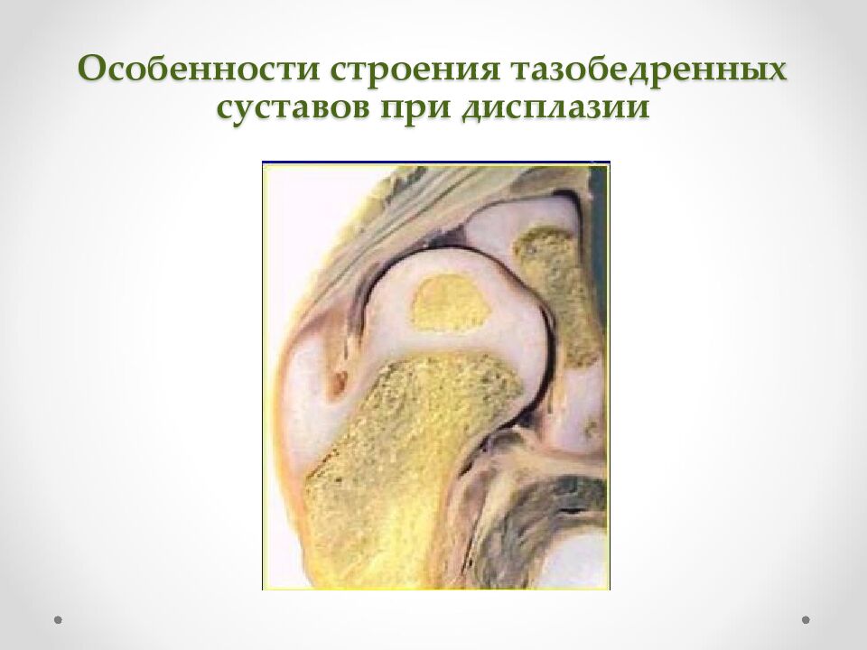Особенности строения тазобедренных суставов при дисплазии