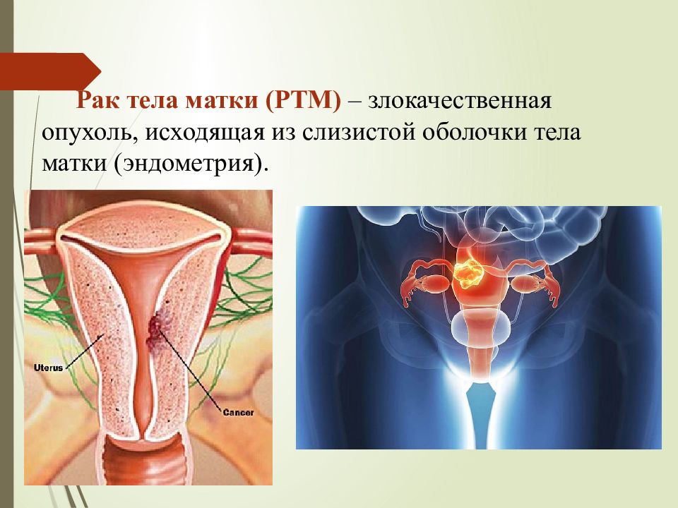 Рак тела матки картинки